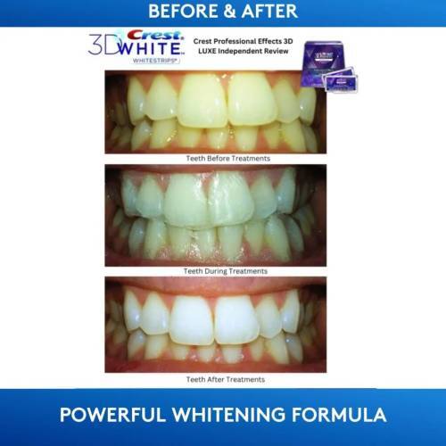 before and after crest whitening strips