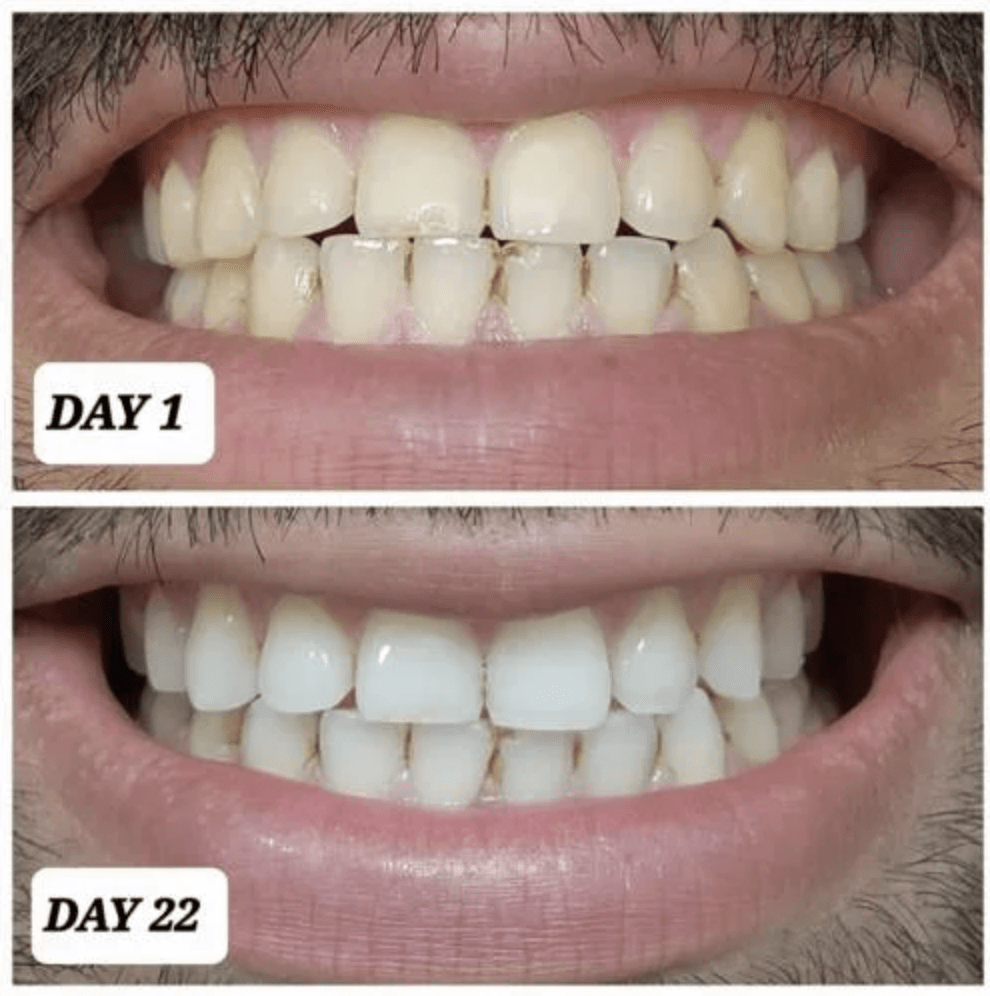 crest strips before and after