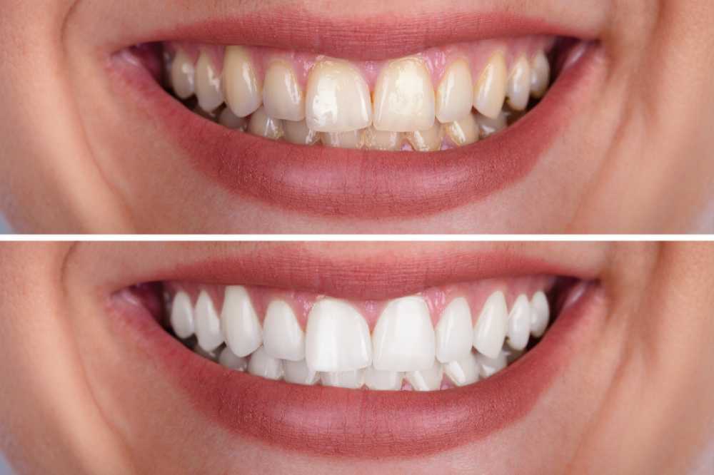 3-Types-of-Tooth-Stains-How-To-Reduce-Them