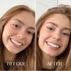 before and after crest glamorous whitestrips