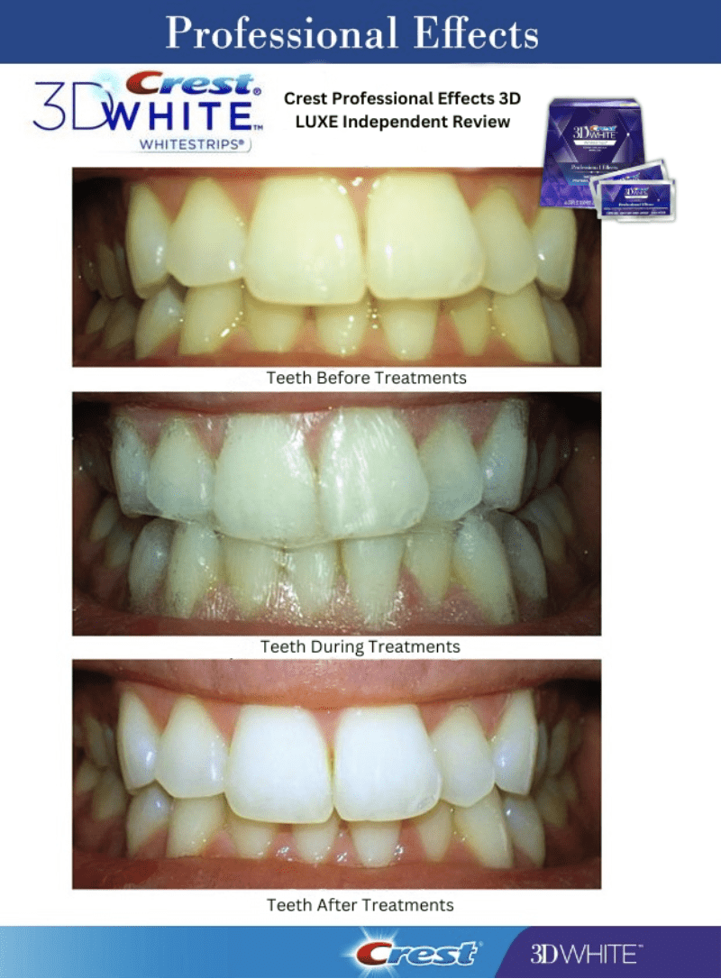 crest teeth whitening strips before and after