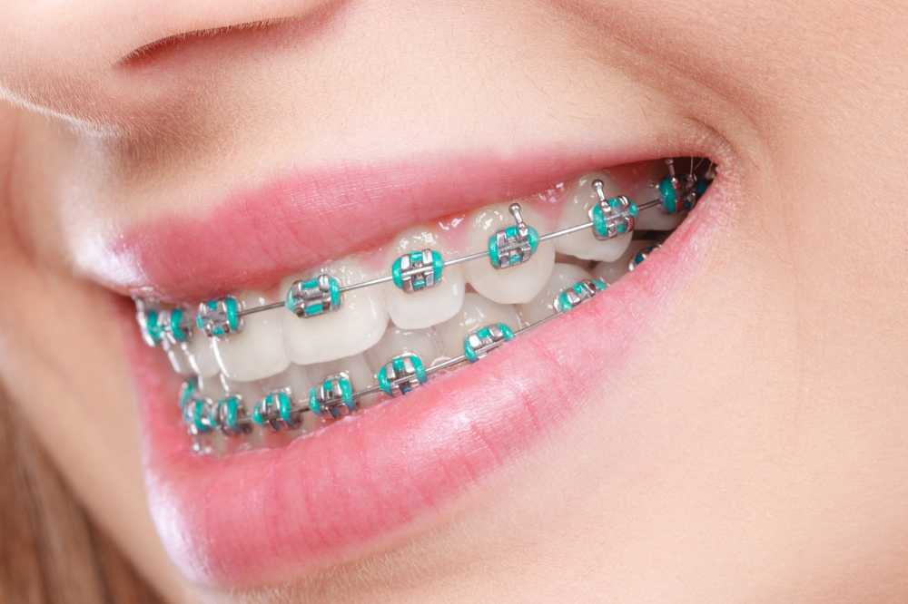 Teeth Whitening Strips With Braces