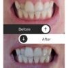 crest teeth whitening before and after