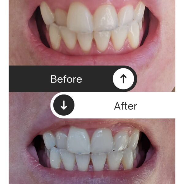 crest teeth whitening before and after