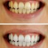 crest teeth whitening results