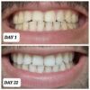 crest whitening results
