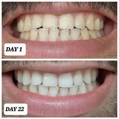 crest whitening results