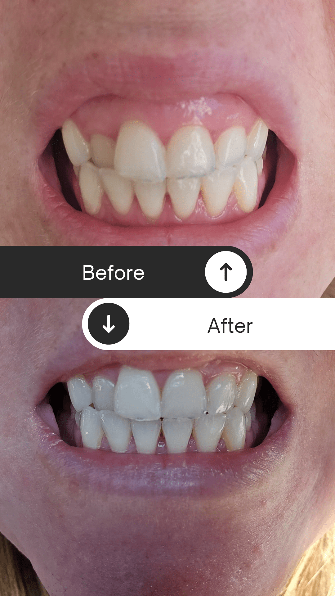 crest whitestrips before and after